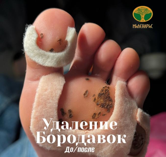 Эффективное удаление бородавок и папиллом в Миленарис